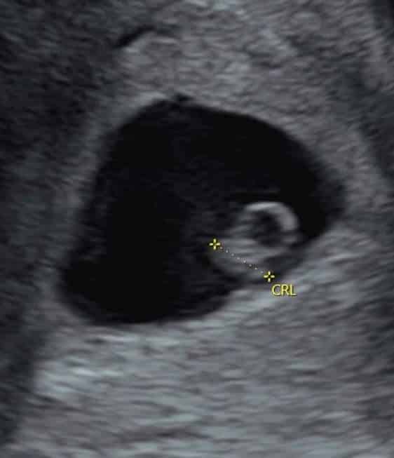 Photo - Babyvue