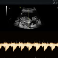 Photo - Babyvue